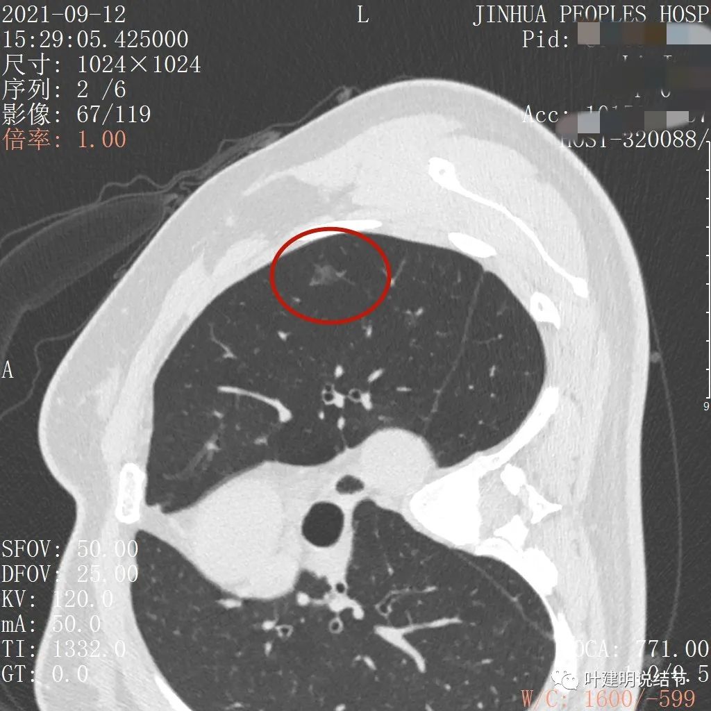 从活检怎么看是非小细胞癌,从病例谈辨证论治