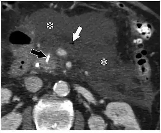 简述急性胰腺炎影像学表现,有关急性胰腺炎疼痛的图片