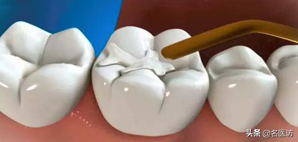 如果蛀牙已经烂了怎么办,如果蛀牙只剩一点牙根了咋办