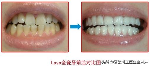 全瓷牙和烤瓷牙哪个更结实,钴铬合金烤瓷牙和全瓷牙优缺点