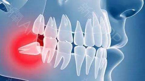 周冬雨拔的是哪颗智齿,周冬雨拔智齿脸肿成了表情包