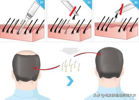 米诺地尔治疗男性脱发有效果吗,米诺地尔治疗脱发