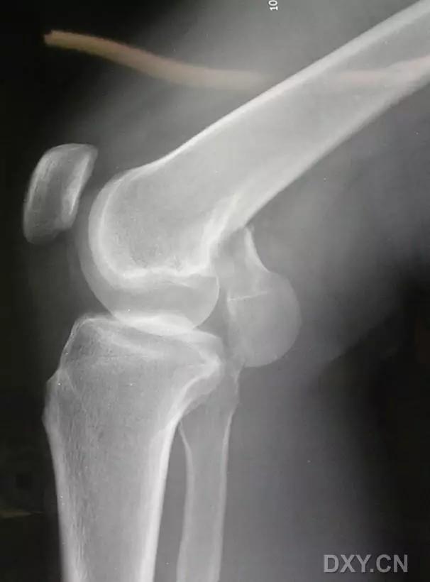 特殊骨折类型,特殊骨折体征