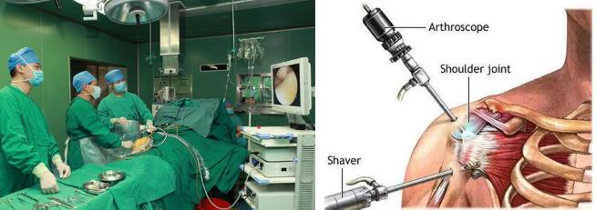 习惯性肩关节脱位怎么办,怎么检查肩关节是不是习惯性脱位