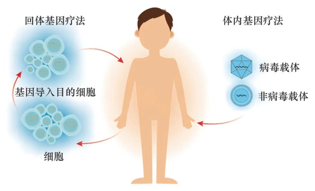 基因疗法：单基因遗传疾病患者治愈的新希望