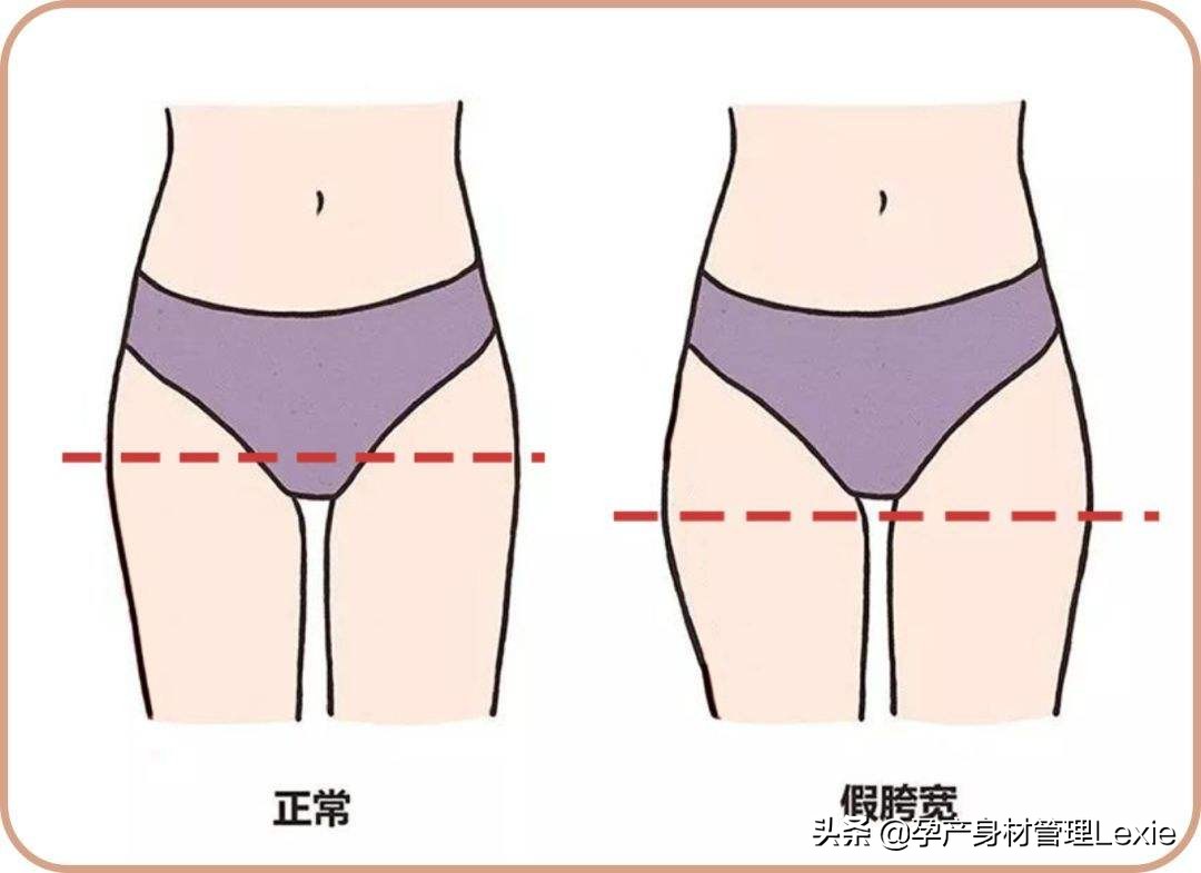 生完娃胯宽屁股大可能是种病,生孩子后胯部宽了怎么修复