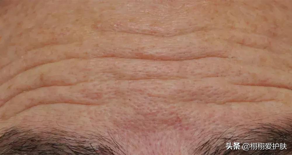 如何去除抬头纹和川字纹,抬头纹用什么方法去除呢