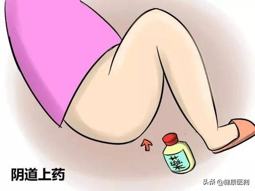 阴道炎的各种症状及治疗用药,常见的阴道炎的症状及治疗措施