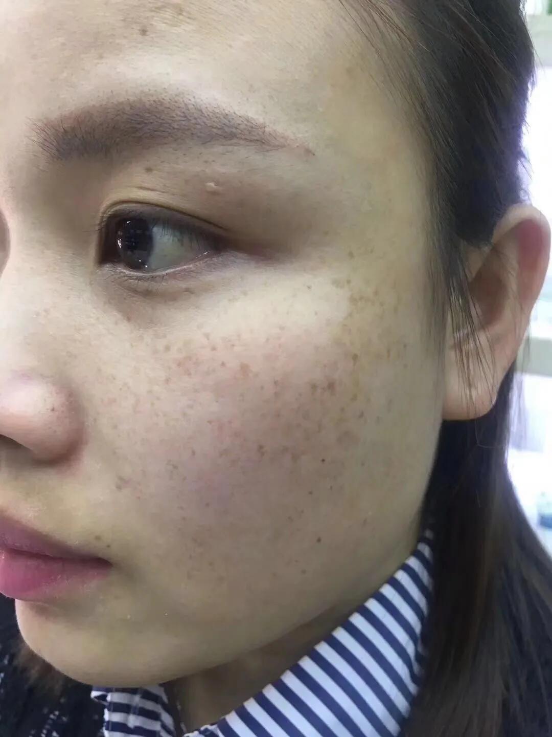 遗传性雀斑食疗方法,遗传性雀斑祛斑霜