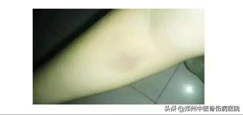 抽血后没按紧有淤血,抽血后按压出现淤血疼怎么办