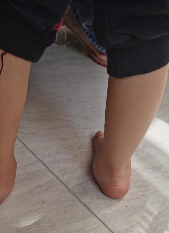 预防足外翻的绑带,儿童买鞋预防足外翻