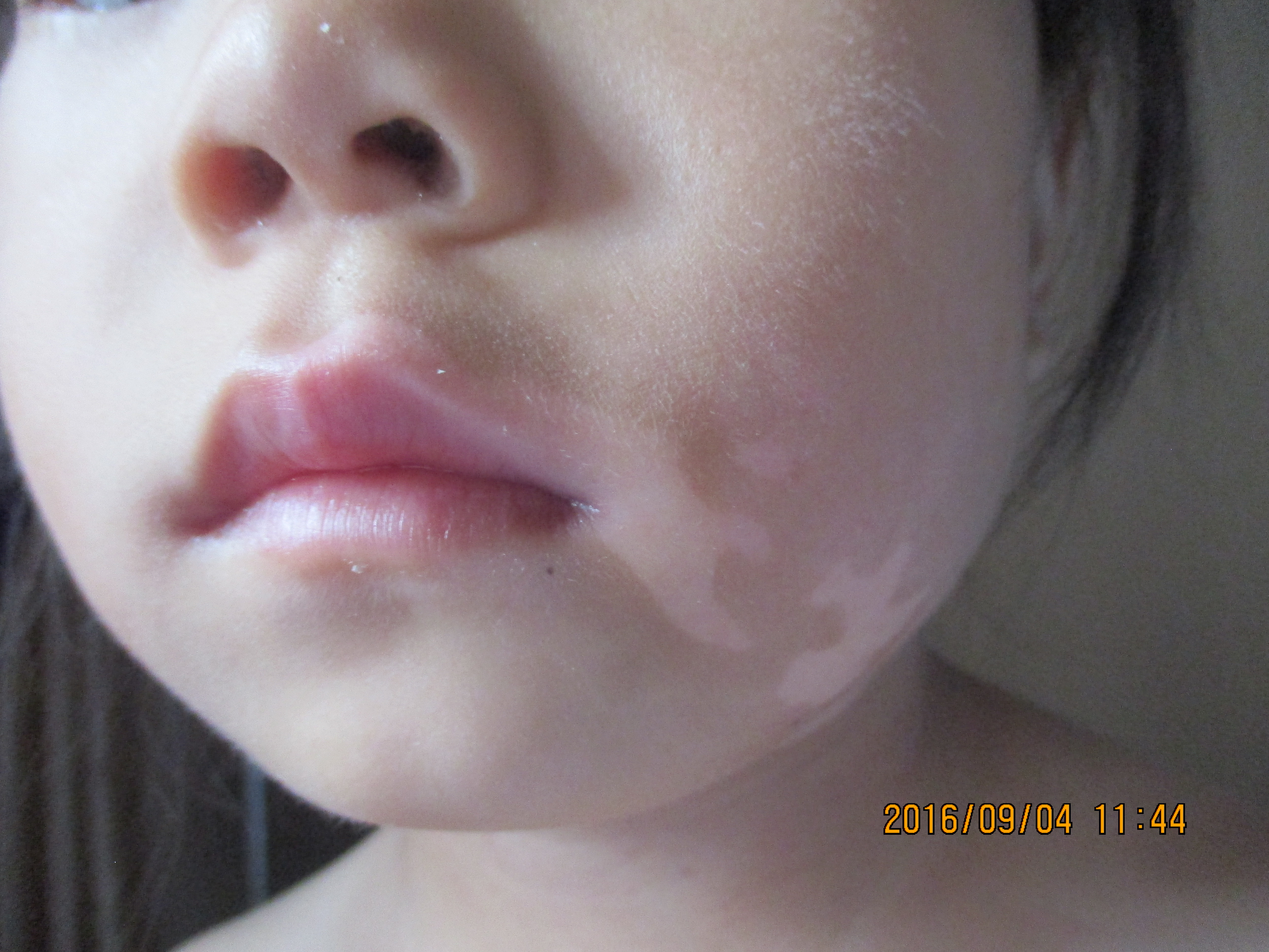 小孩缺锌脸上长的白斑叫什么,小孩脸上长白斑怎么办啊