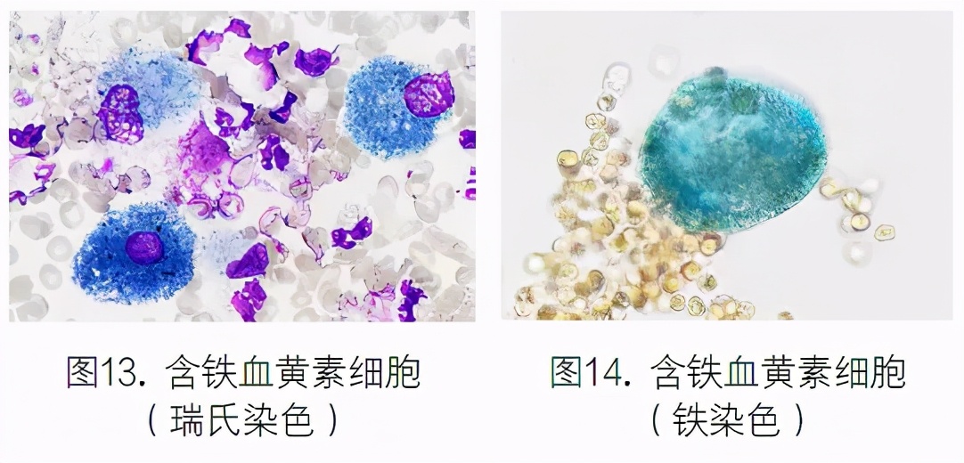 支气管肺泡灌洗液检测技术规范,肺泡灌洗液肿瘤细胞检查准确性