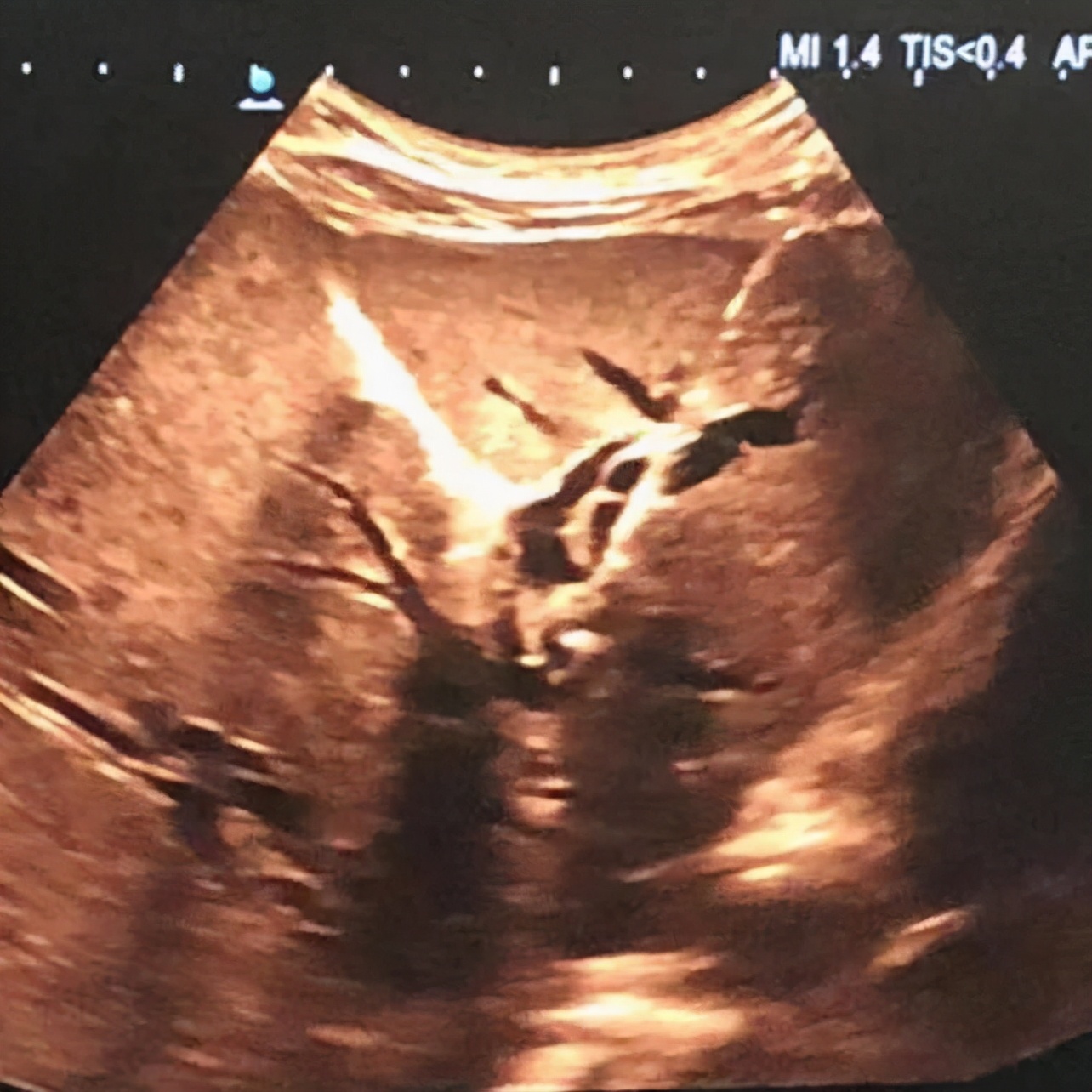 梗阻性黄疸ptcd引流管一般戴多久,梗阻性黄疸的诊疗