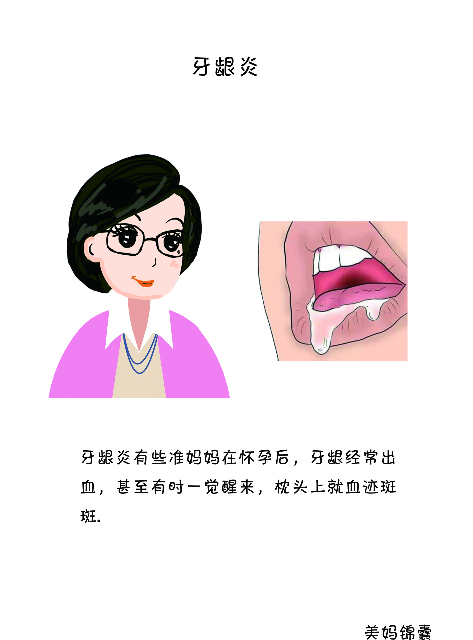 孕期牙龈炎严重怎么办,孕期牙龈炎老出血