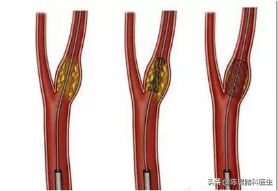 老年人换季输液好吗,老年人脑梗一般要挂多久的水