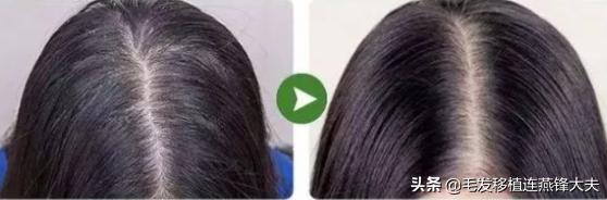 每天洗头头皮屑还是很多怎么解决,天天洗头却有很多头皮屑怎么解决