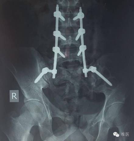 尾骶骨骨折错位突出怎么办,骶骨骨折能手法复位吗