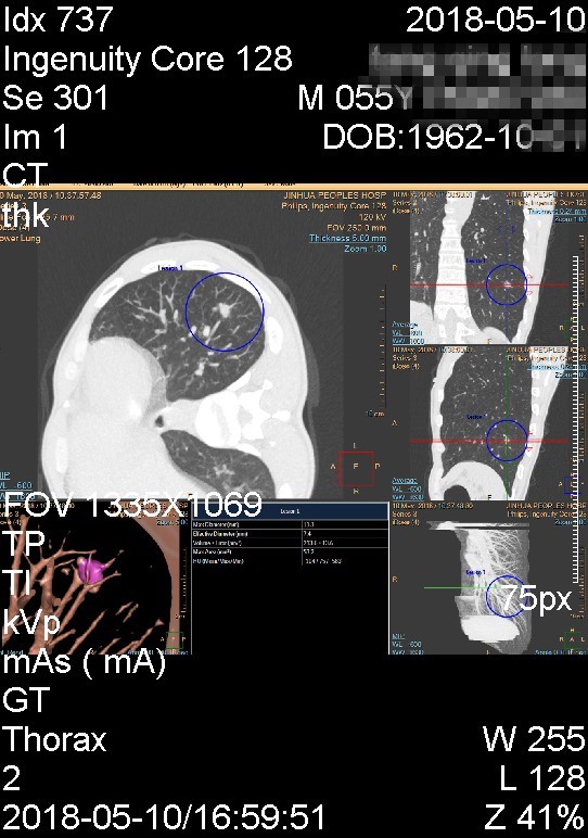 结节恶性良性做什么鉴别,恶性肺结节哪些指标偏高