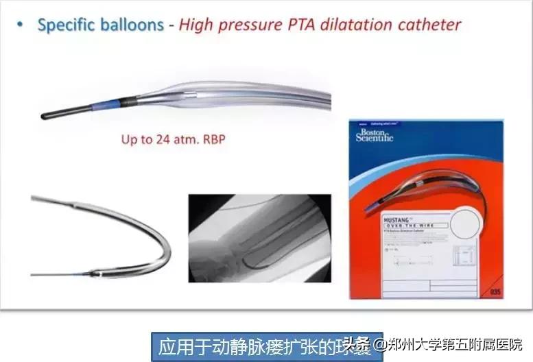 科普关于动静脉瘘手术,动静脉瘘是怎么治疗最好