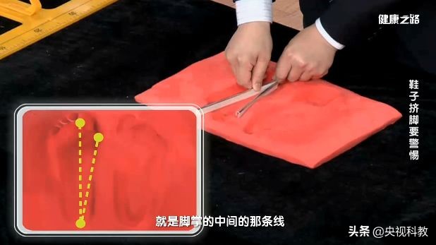 让你又丑又疼的拇外翻矫正方法在这里！还有测试哦