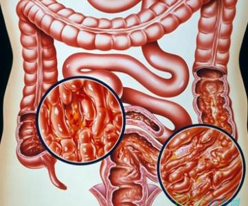 溃疡性结肠炎也会转化成癌？一旦出现这3种迹象，十有八九在癌变