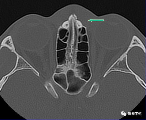 鼻骨影像学解剖,鼻骨解剖及骨折影像学诊断