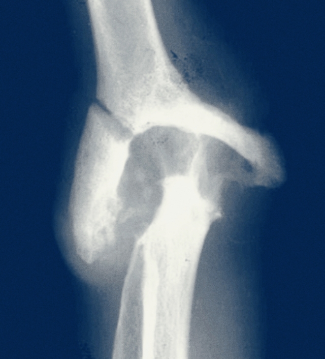 胳膊肘弯曲伸不直有10多年怎么办,胳膊肘转动但是不动