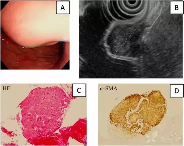 超声胃镜粘膜下隆起低回声占位,胃镜显示食道粘膜下隆起5mm