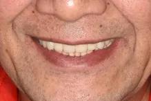 长沙牙齿种植的费用,长沙半口种植牙齿的过程