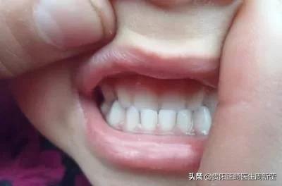 12岁前必须解决的错颌畸形,孩子十二岁牙畸形怎么办