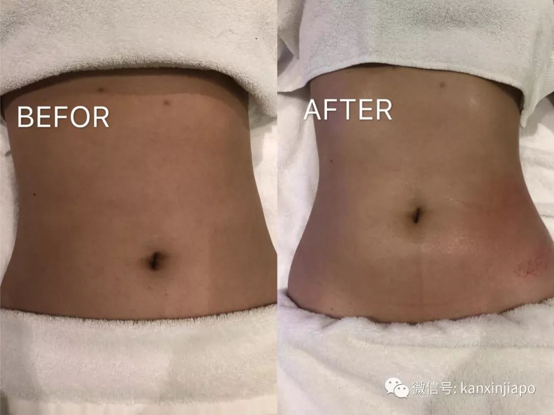 额头长闭口毛孔粗大爆痘怎么办,皮肤爆痘起闭口怎么回事