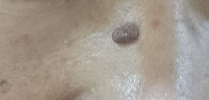 鼻梁上长了一个硬疙瘩是怎么回事,鼻梁上长了个黑色肉粒怎么回事