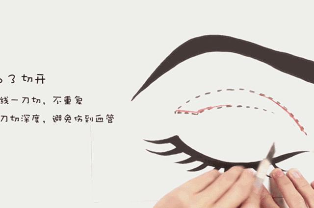割双眼皮埋线和全切有什么区别,全切双眼皮内眼角割的不一样