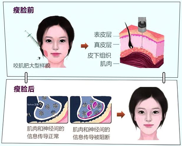 瘦脸针小v脸几天见效果,瘦脸针打完后几天出效果