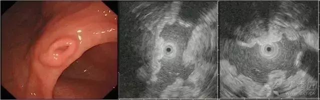 超声胃镜粘膜下隆起低回声占位,胃镜显示食道粘膜下隆起5mm