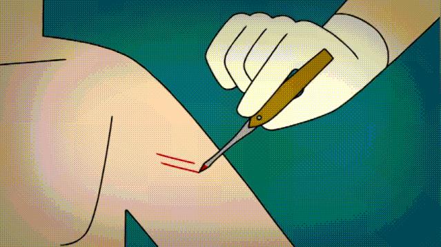 人痘苗接种法谁发明的,人痘苗