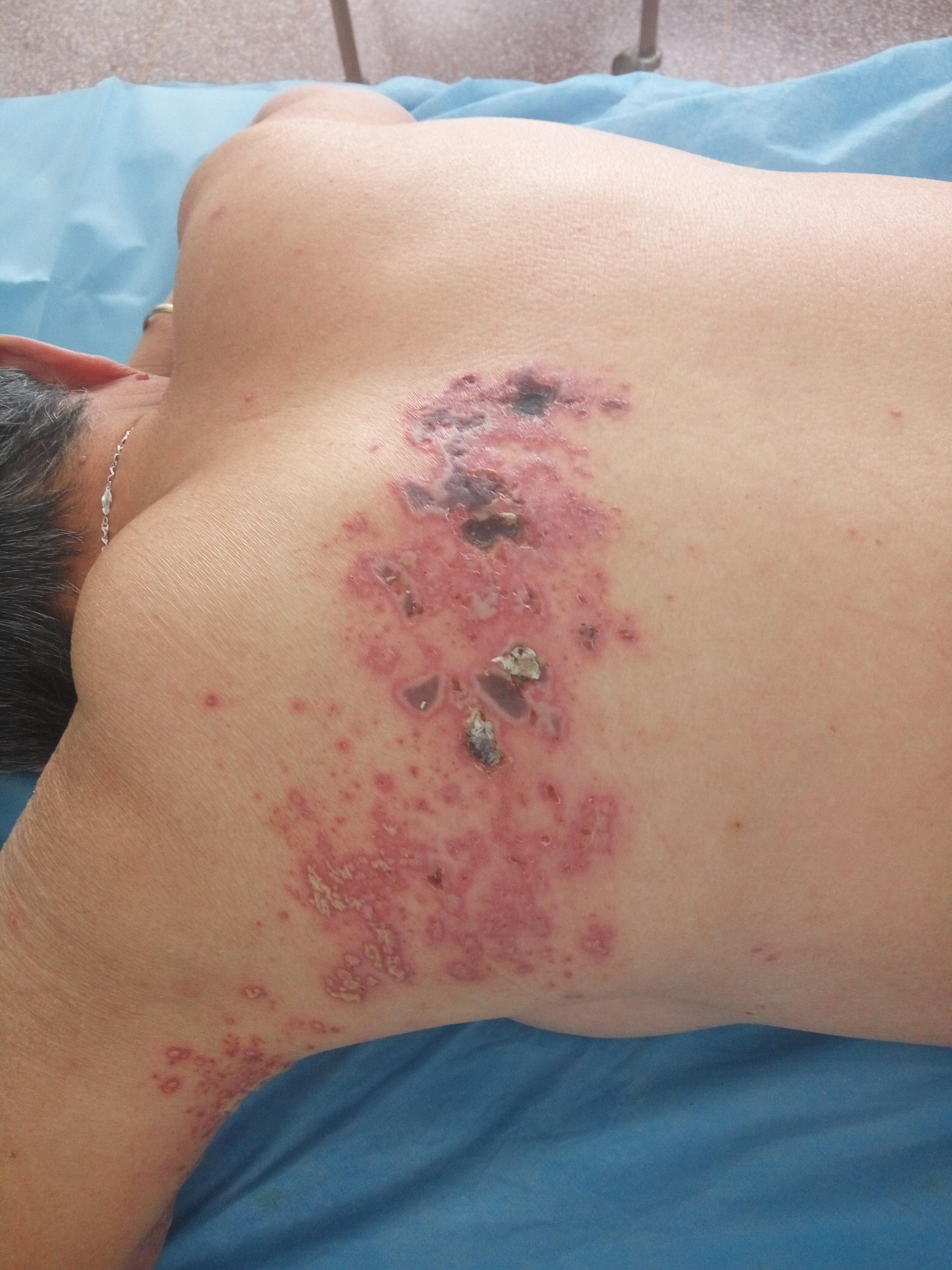 带状疱疹好治疗吗,带状疱疹合并糖尿病为什么难治