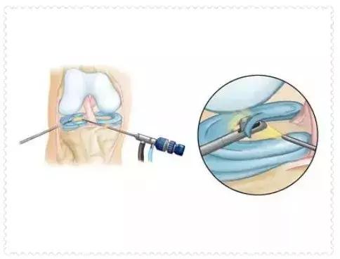 每个人的半月板都一样的吗,你见过长得跟你一模一样的人吗
