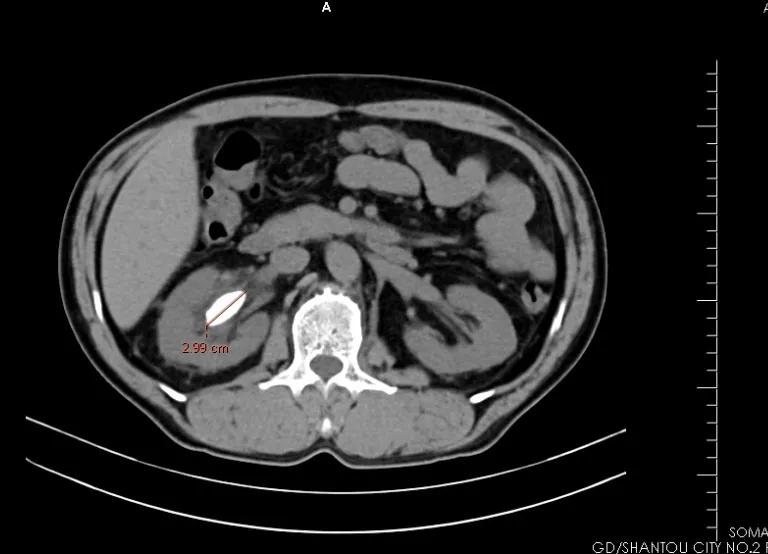 医疗科技最新突破人工肾,医学技术泌尿系统