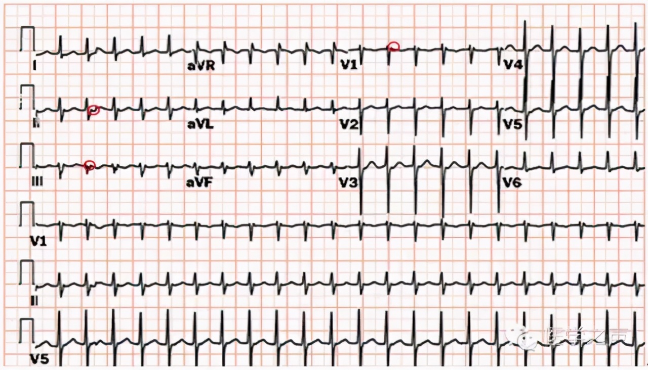 阵发性室上性心动过速是房颤吗,阵发性室上性心动过速中医