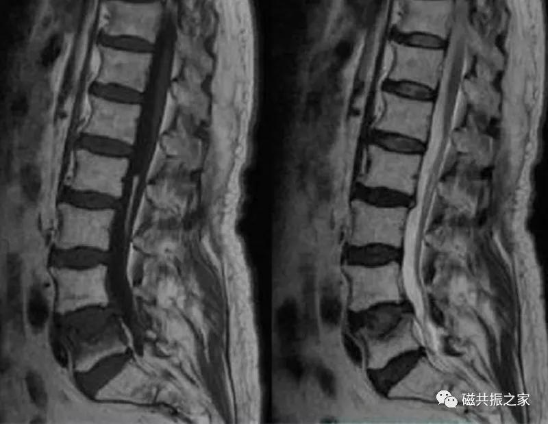 腰椎有哪些病变,腰椎病变有几种