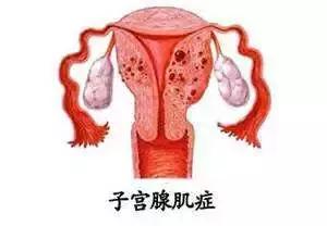 聚焦超声手术治疗能根治子宫腺肌病吗？