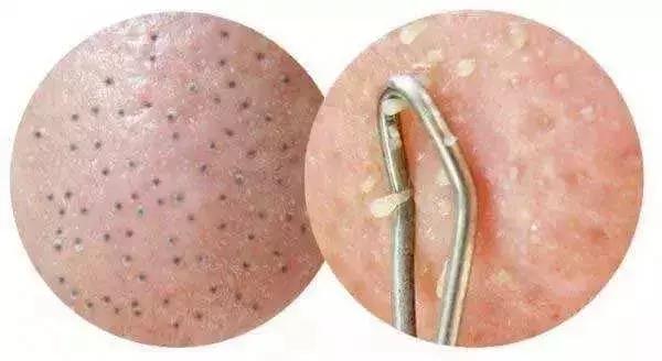 人人都会长黑头吗,好多人都长黑头吗