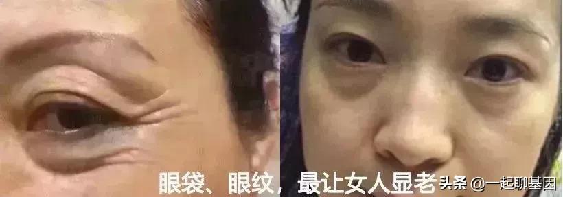 大眼袋眼纹抹平了,眼纹医美怎么去除