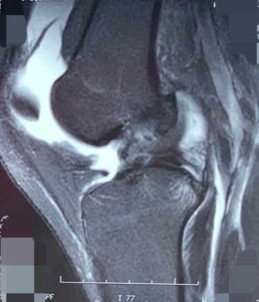半月板撕裂多长时间能完全恢复nba,半月板受伤有没有完全恢复的可能