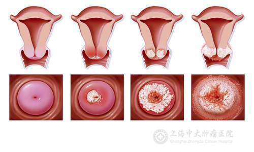“宫颈糜烂”会变成宫颈癌吗？怎么预防？