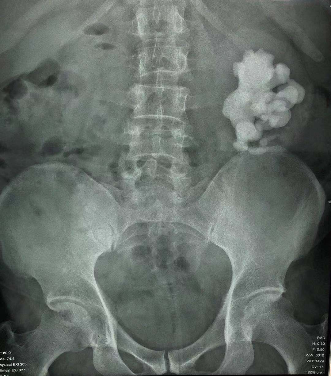 疯狂的石头除藻,肾结石鹿角形状的结石什么样