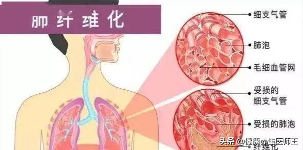 急性肺损伤诊断标准,急性肺损伤辨证