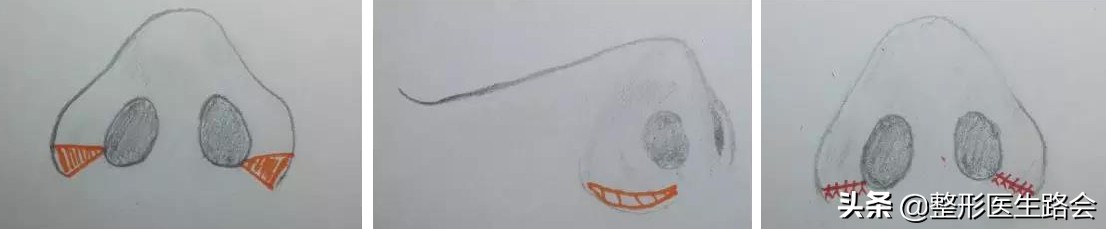 鼻翼缩小会有什么影响,鼻翼缩小会不会影响鼻子呼吸